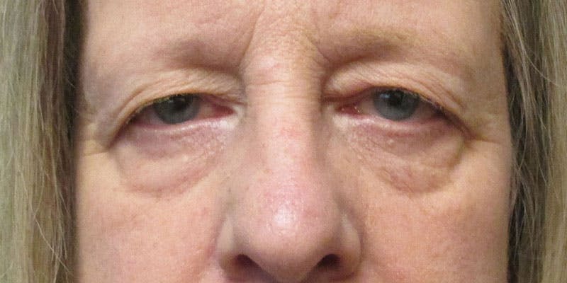 Eyelid Surgery Gallery - Patient 87850546 - Image 1