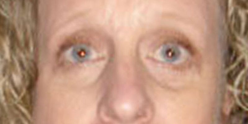 Eyelid Surgery Gallery - Patient 87850546 - Image 2