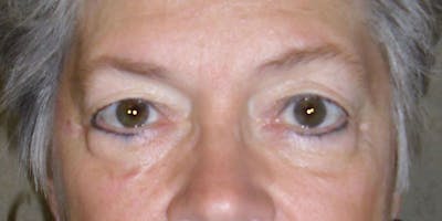 Eyelid Surgery Before & After Gallery - Patient 87850547 - Image 1