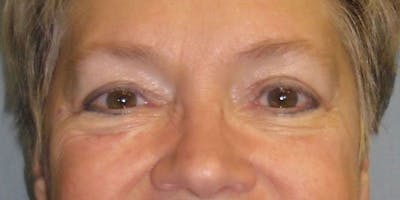 Eyelid Surgery Before & After Gallery - Patient 87850547 - Image 2