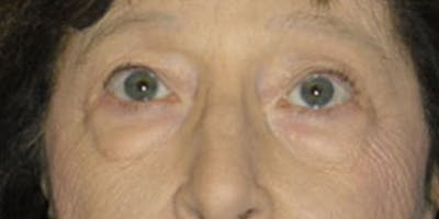 Eyelid Surgery Before & After Gallery - Patient 87850548 - Image 1
