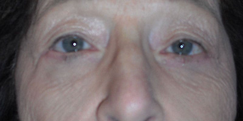 Eyelid Surgery Gallery - Patient 87850548 - Image 2