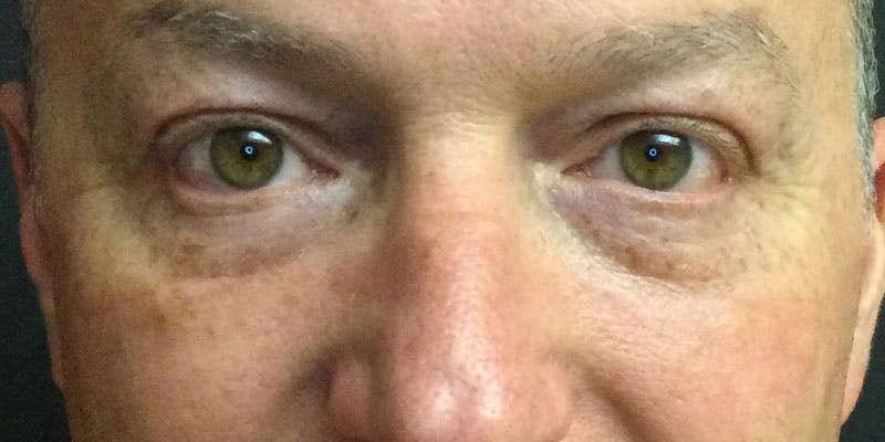 Eyelid Surgery Before & After Gallery - Patient 87850549 - Image 2