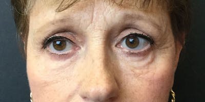 Eyelid Surgery Before & After Gallery - Patient 87850550 - Image 2