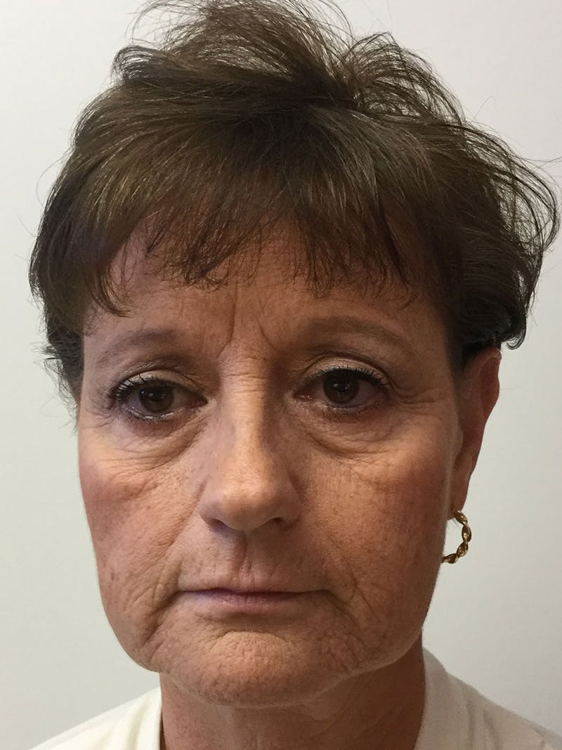 Facelift Before & After Gallery - Patient 95813405 - Image 1