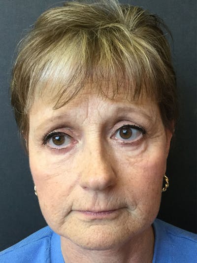 Facelift Before & After Gallery - Patient 95813405 - Image 2