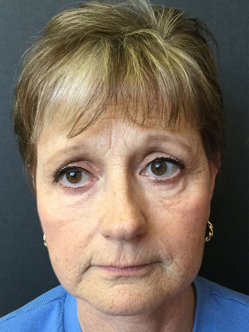 Facelift Before & After Gallery - Patient 95813405 - Image 4
