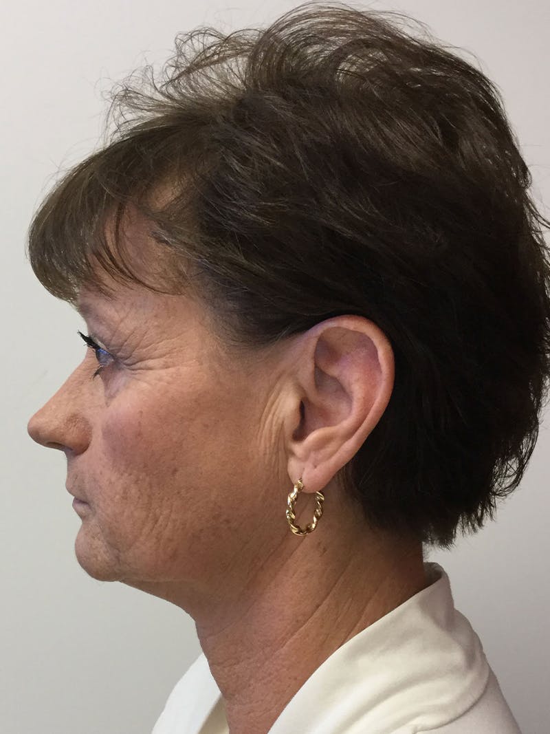 Facelift Before & After Gallery - Patient 95813405 - Image 1