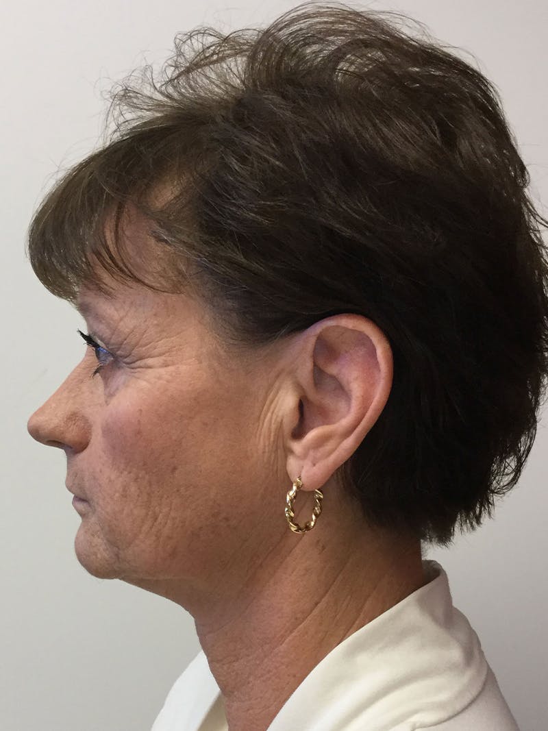 Facelift Before & After Gallery - Patient 95813405 - Image 3