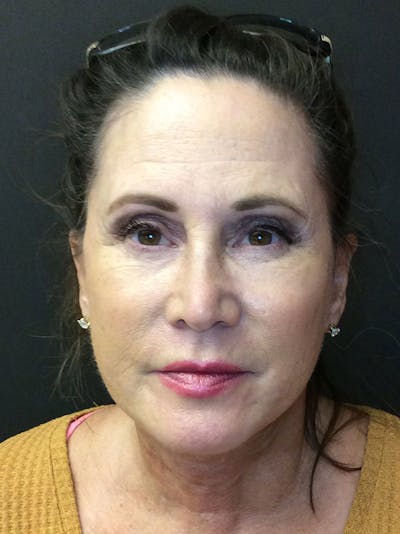 Facelift Before & After Gallery - Patient 95813406 - Image 2