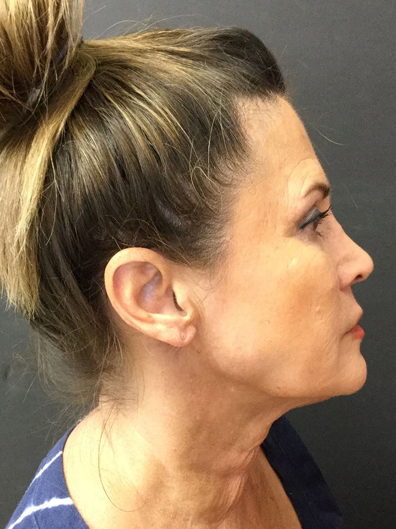 Facelift Before & After Gallery - Patient 95813406 - Image 3