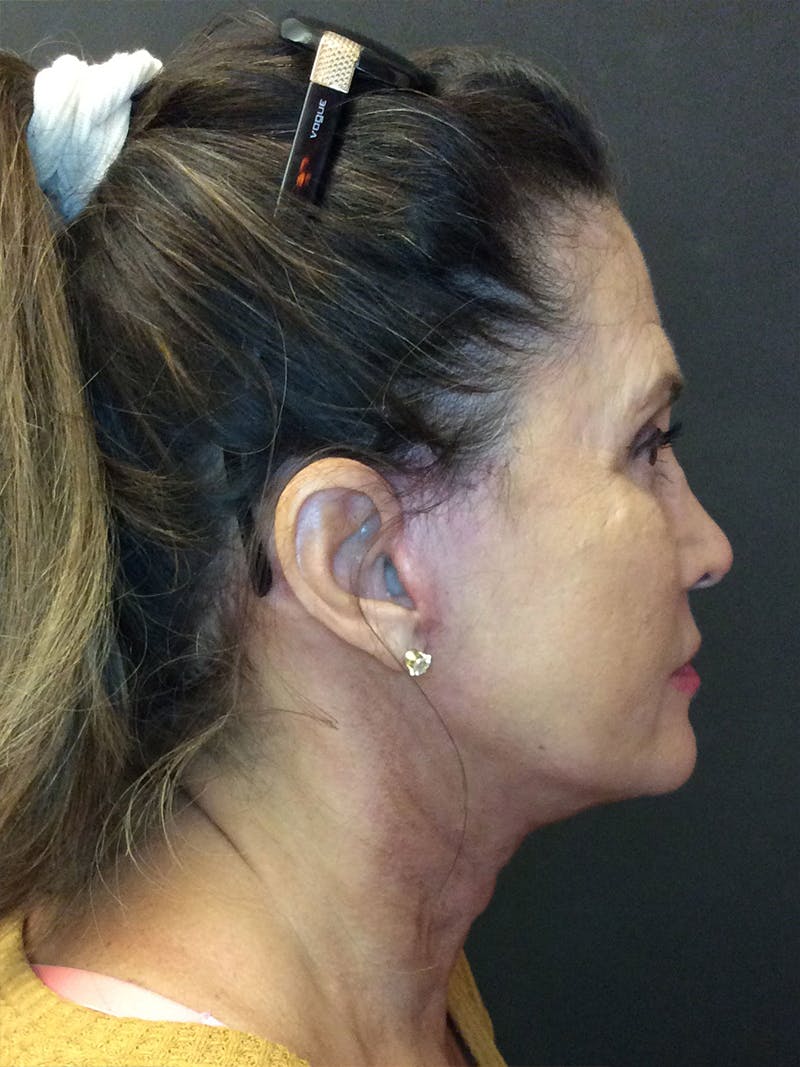 Facelift Before & After Gallery - Patient 95813406 - Image 4