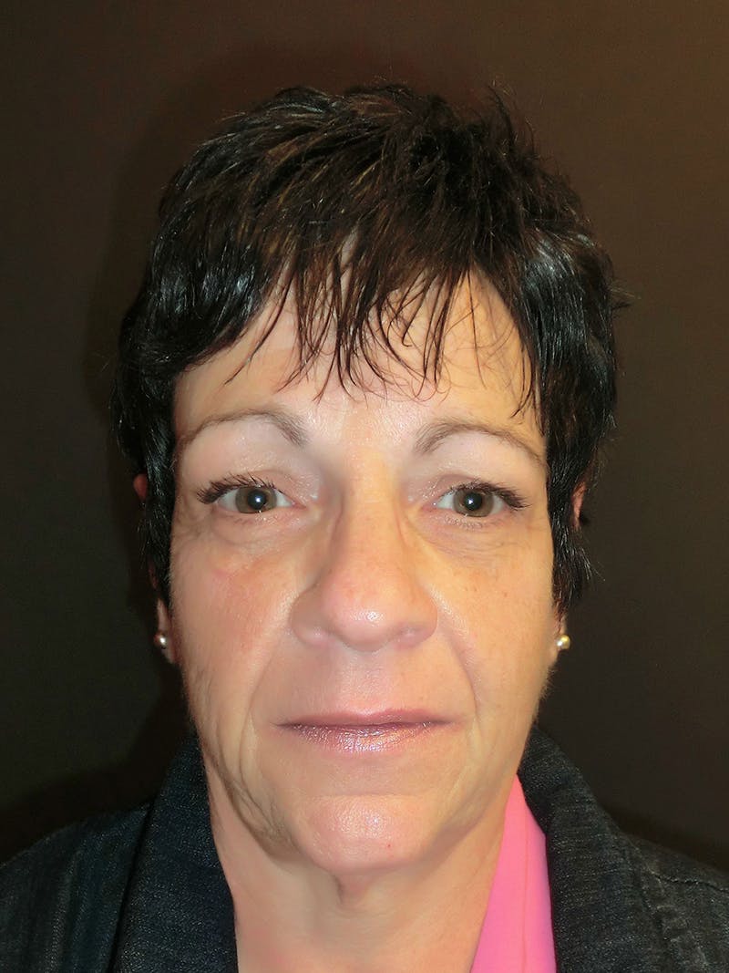 Facelift Before & After Gallery - Patient 95813407 - Image 1