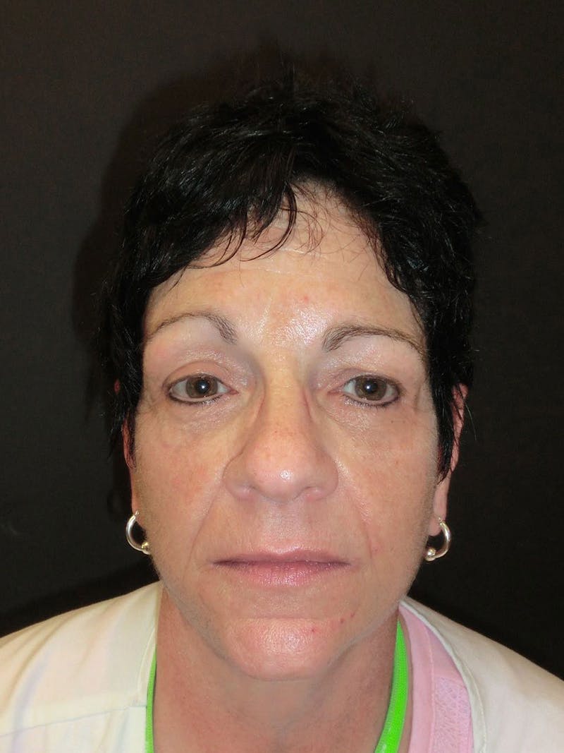 Facelift Before & After Gallery - Patient 95813407 - Image 4