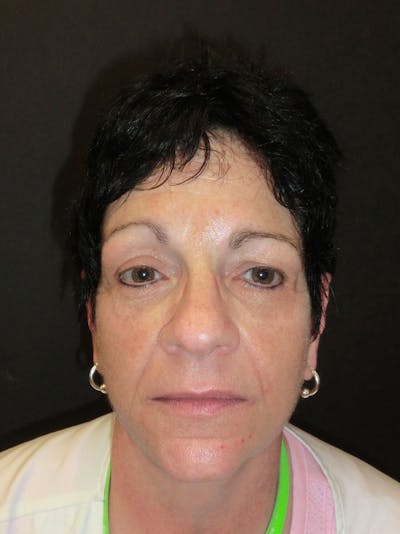 Facelift Before & After Gallery - Patient 95813407 - Image 2