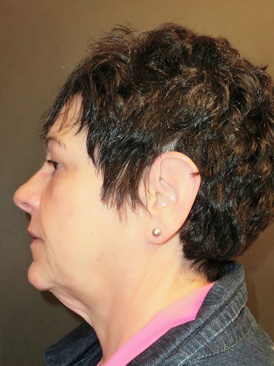 Facelift Before & After Gallery - Patient 95813407 - Image 1