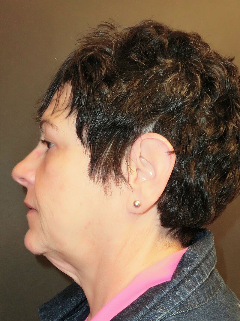 Facelift Before & After Gallery - Patient 95813407 - Image 3