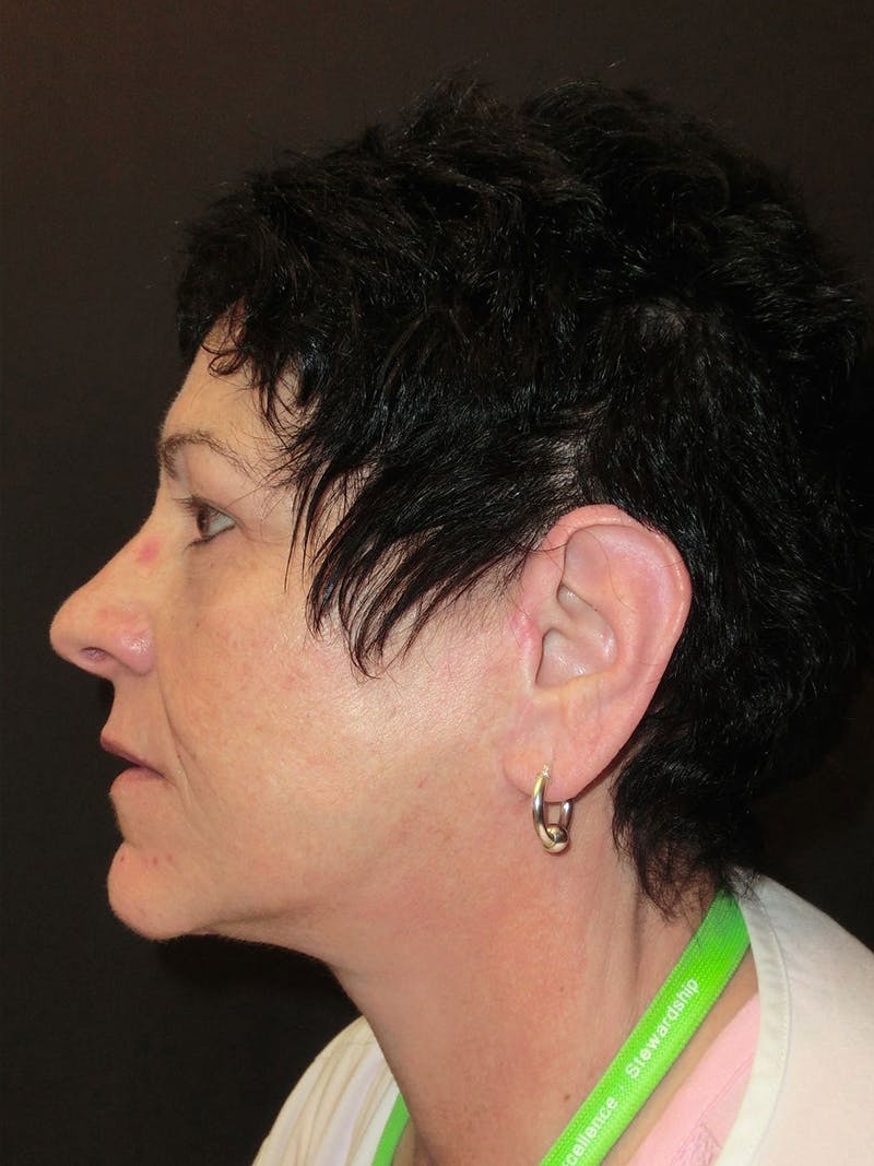 Facelift Before & After Gallery - Patient 95813407 - Image 4