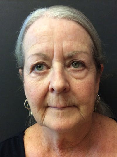 Facelift Before & After Gallery - Patient 95813408 - Image 1