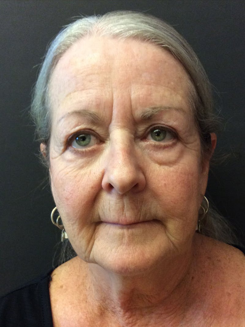 Facelift Before & After Gallery - Patient 95813408 - Image 1