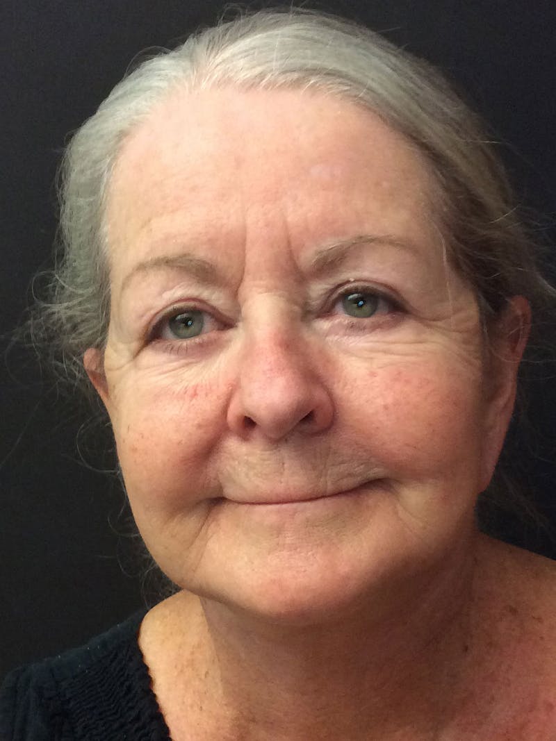 Facelift Before & After Gallery - Patient 95813408 - Image 2