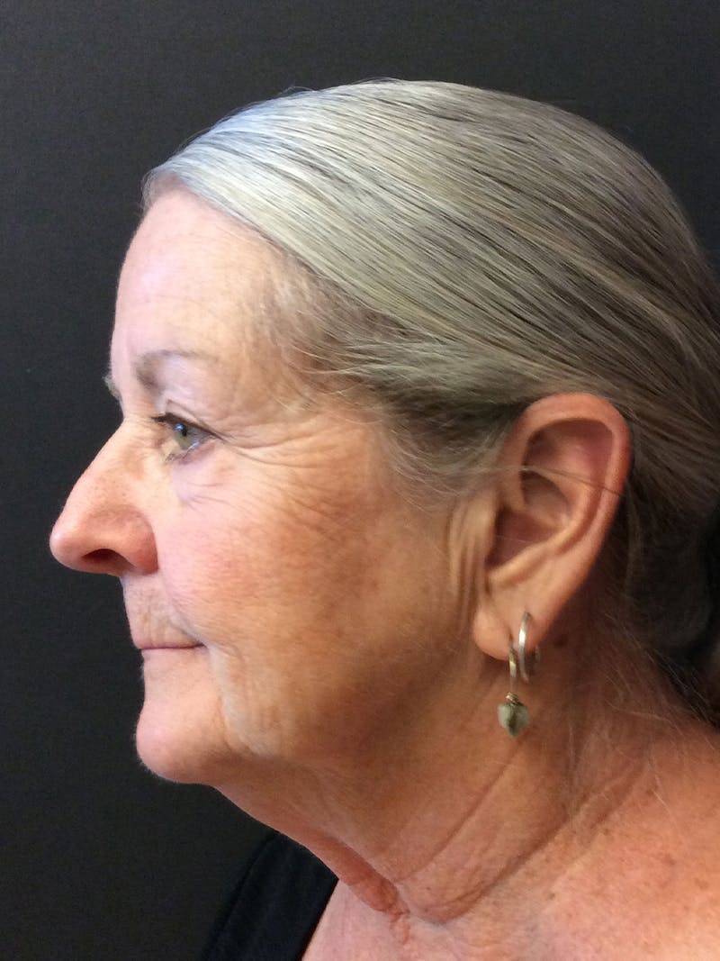 Facelift Before & After Gallery - Patient 95813408 - Image 3