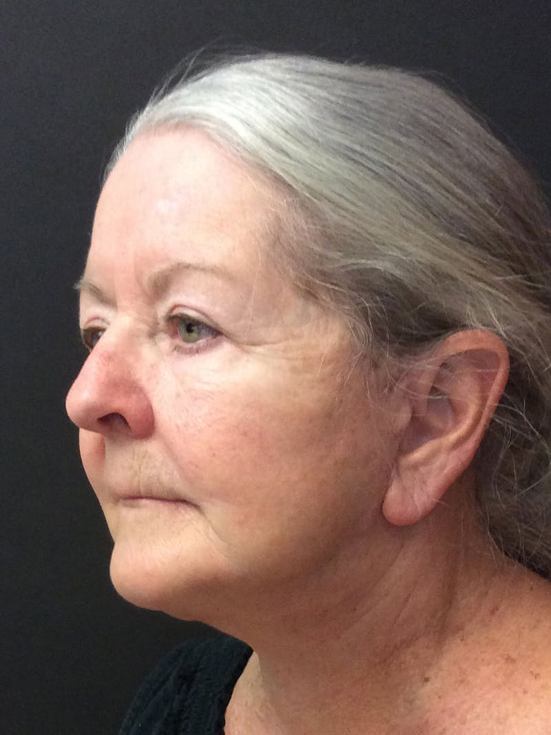 Facelift Before & After Gallery - Patient 95813408 - Image 4