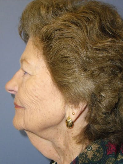Facelift Before & After Gallery - Patient 95813460 - Image 1