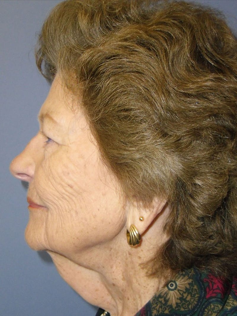 Facelift Before & After Gallery - Patient 95813460 - Image 3