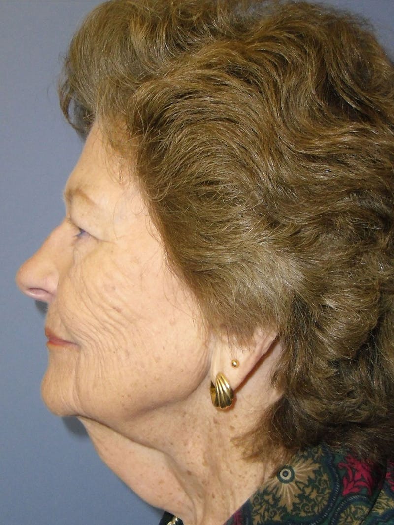 Facelift Before & After Gallery - Patient 95813460 - Image 1