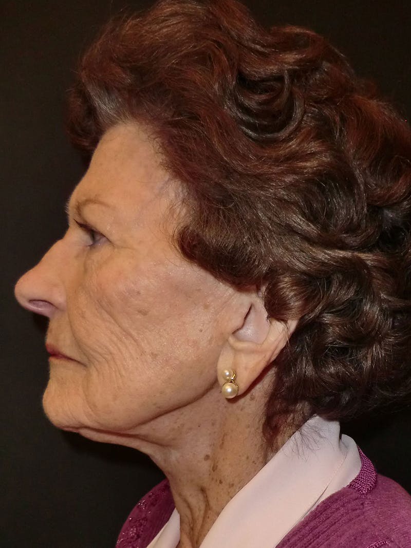 Facelift Before & After Gallery - Patient 95813460 - Image 4