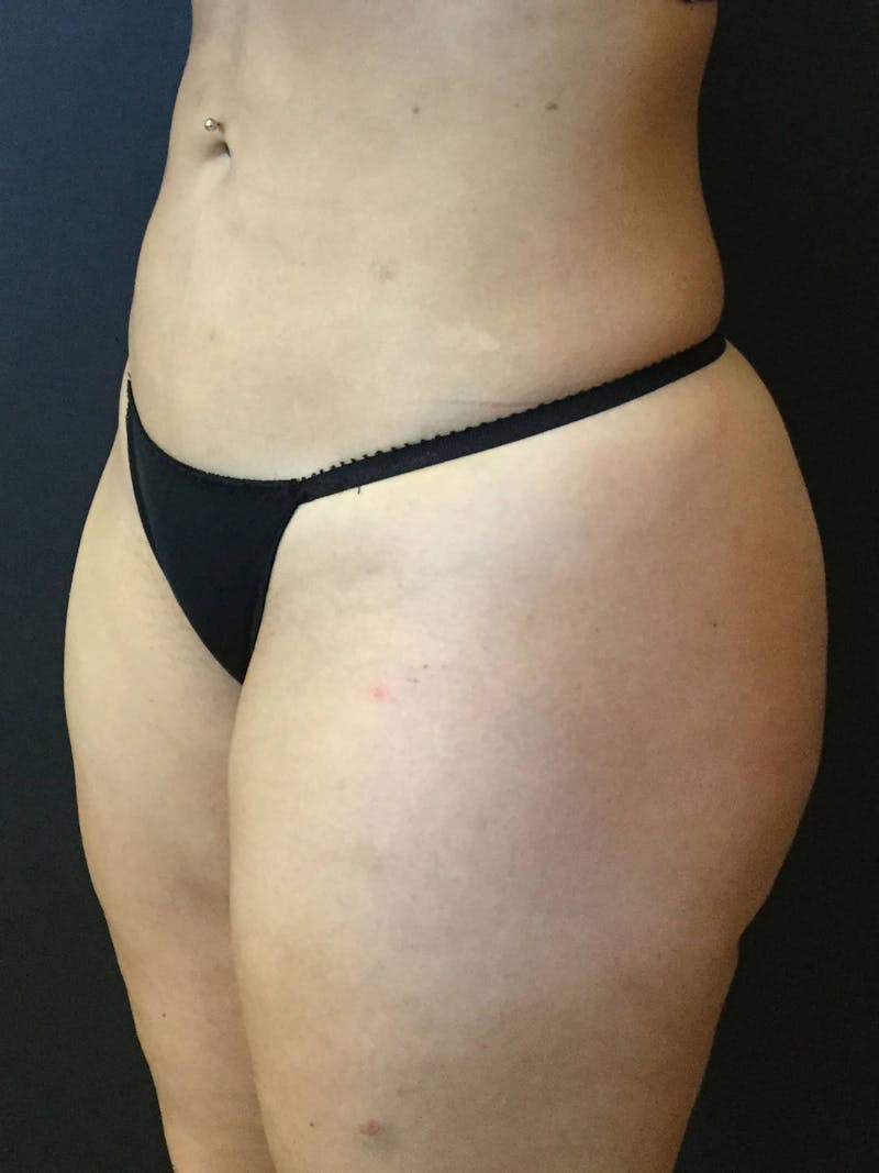 Liposuction Before & After Gallery - Patient 99665689 - Image 4