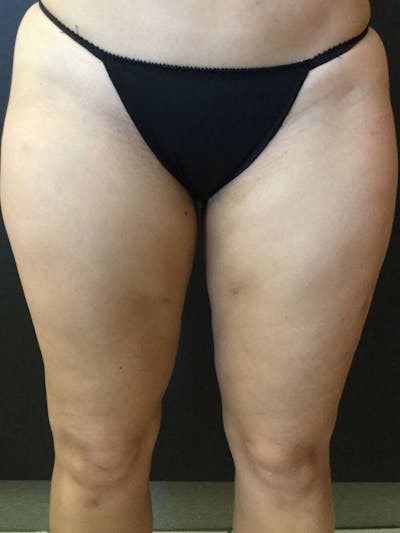 Liposuction Before & After Gallery - Patient 99665689 - Image 2