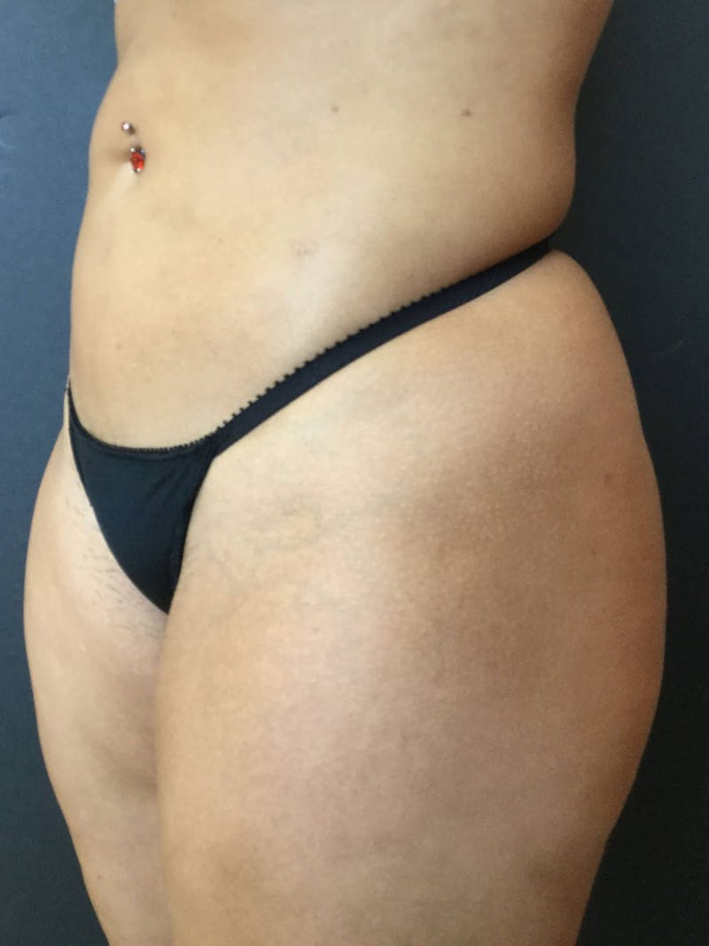Liposuction Before & After Gallery - Patient 99665689 - Image 3