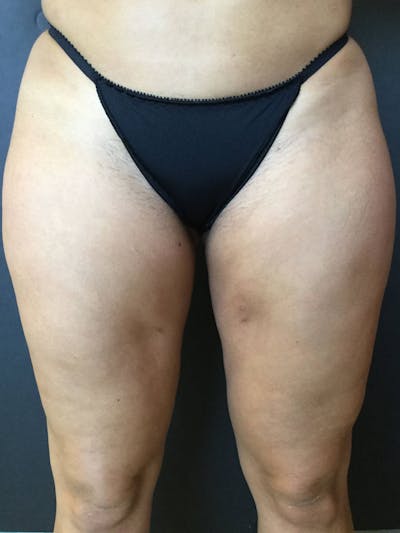 Liposuction Gallery - Patient 99665689 - Image 1