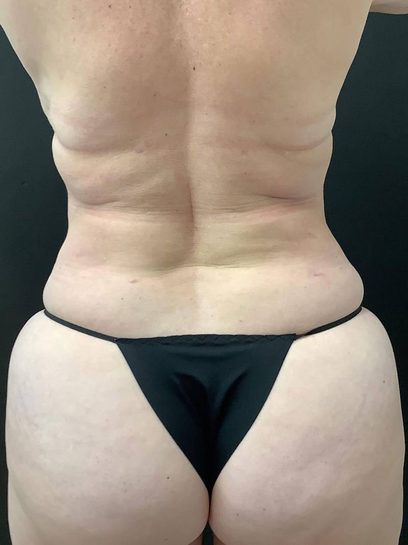Liposuction Gallery - Patient 99665723 - Image 6