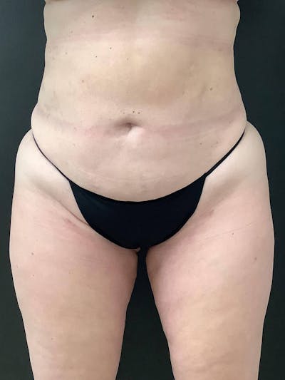 Liposuction Before & After Gallery - Patient 99665723 - Image 2