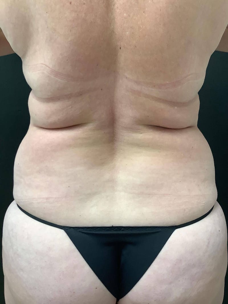 Liposuction Gallery - Patient 99665723 - Image 5