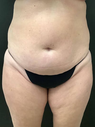 Liposuction Before & After Gallery - Patient 99665723 - Image 1