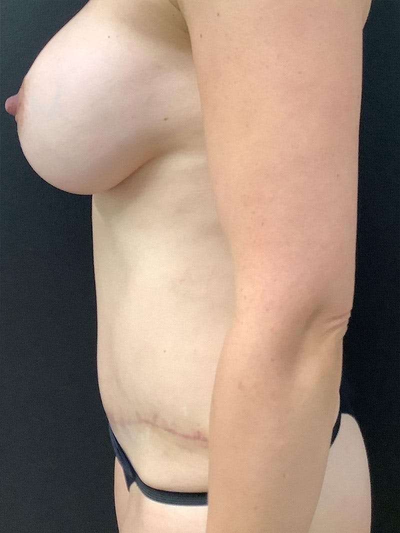 Abdominoplasty Before & After Gallery - Patient 99665840 - Image 6