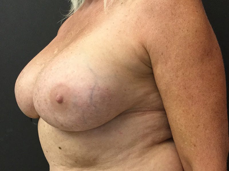 Breast Revision Before & After Gallery - Patient 104046807 - Image 4
