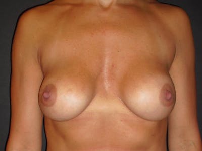 Breast Revision Before & After Gallery - Patient 104046811 - Image 1