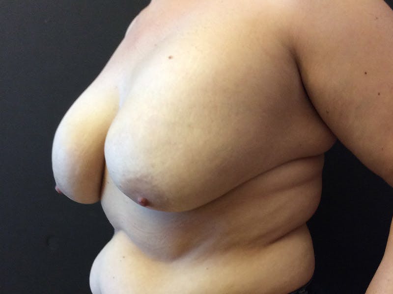 Breast Revision Before & After Gallery - Patient 104046812 - Image 3