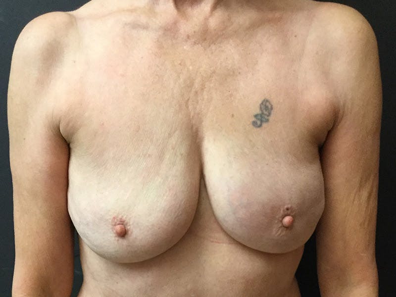 Breast Revision Before & After Gallery - Patient 104046815 - Image 2