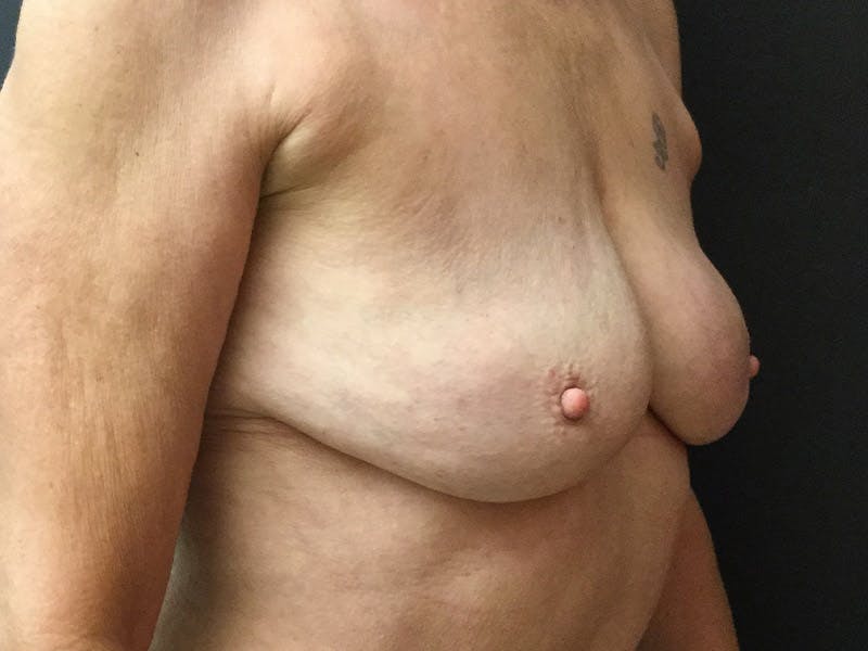 Breast Revision Before & After Gallery - Patient 104046815 - Image 4