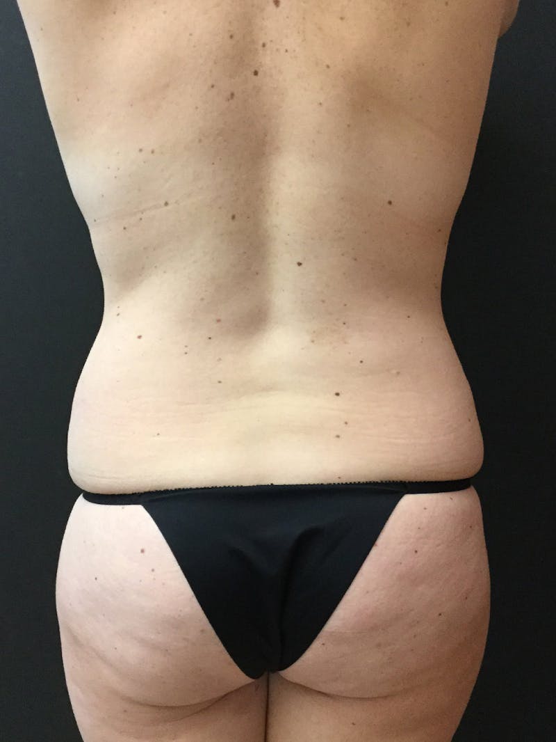 Liposuction Before & After Gallery - Patient 104046835 - Image 5