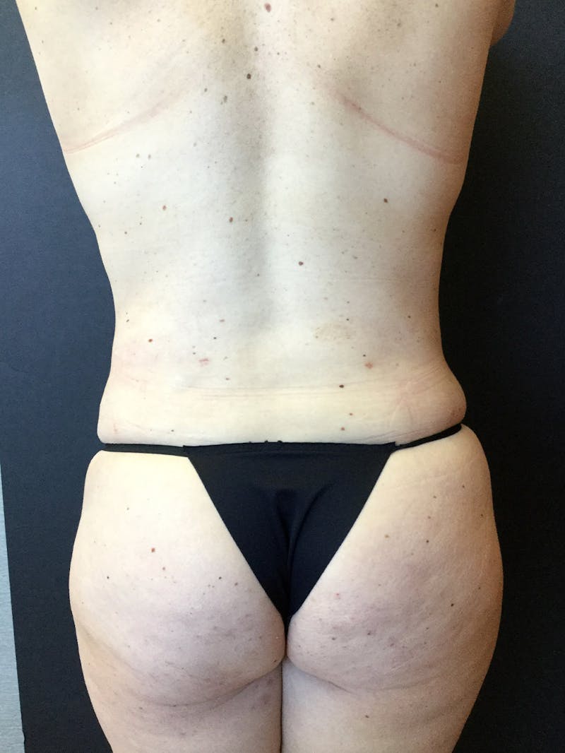 Liposuction Before & After Gallery - Patient 104046835 - Image 6