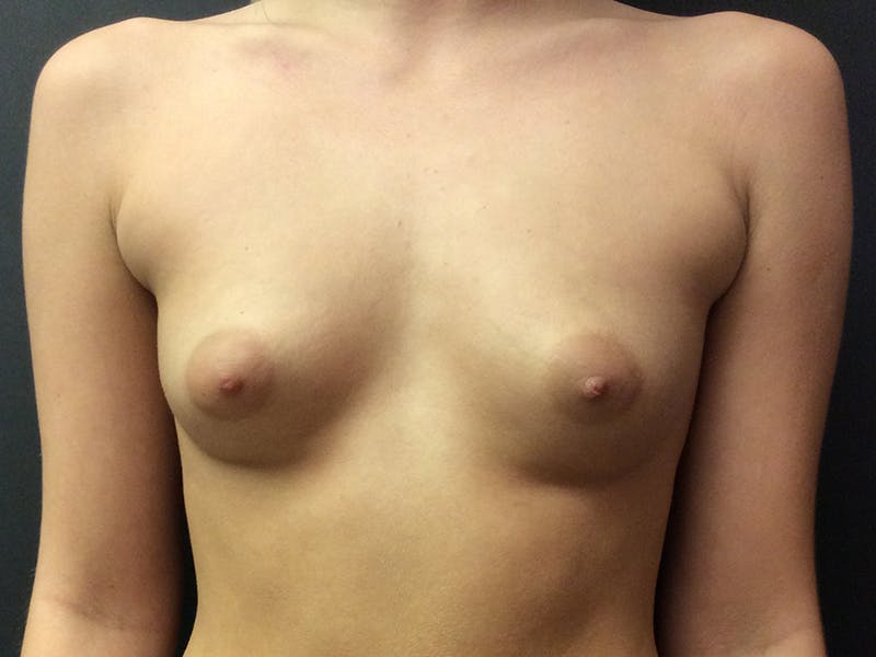 Breast Augmentation Before & After Gallery - Patient 109479456 - Image 1