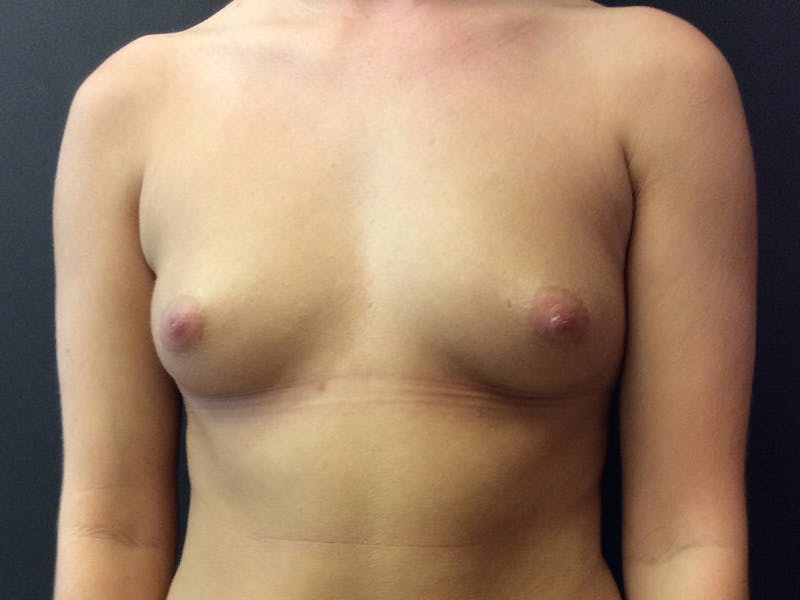 Breast Augmentation Gallery - Patient 109479457 - Image 1