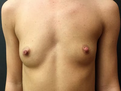 Breast Augmentation Before & After Gallery - Patient 109479459 - Image 1